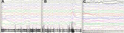 Novel Heterozygous Missense Variant in GRIA4 Gene Associated With Neurodevelopmental Disorder With or Without Seizures and Gait Abnormalities